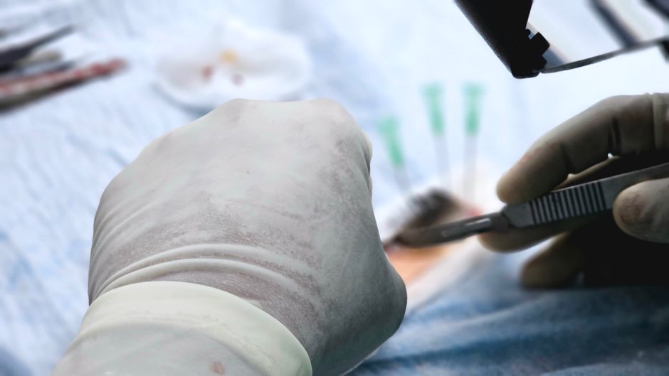 Haartransplantation in der Türkei 2026