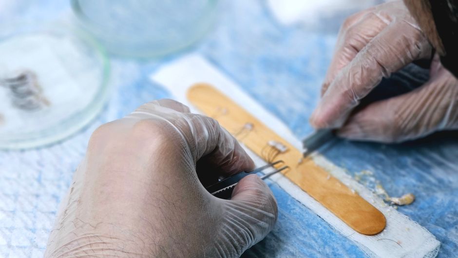 Haartransplantation in einer Klinik in der Türkei